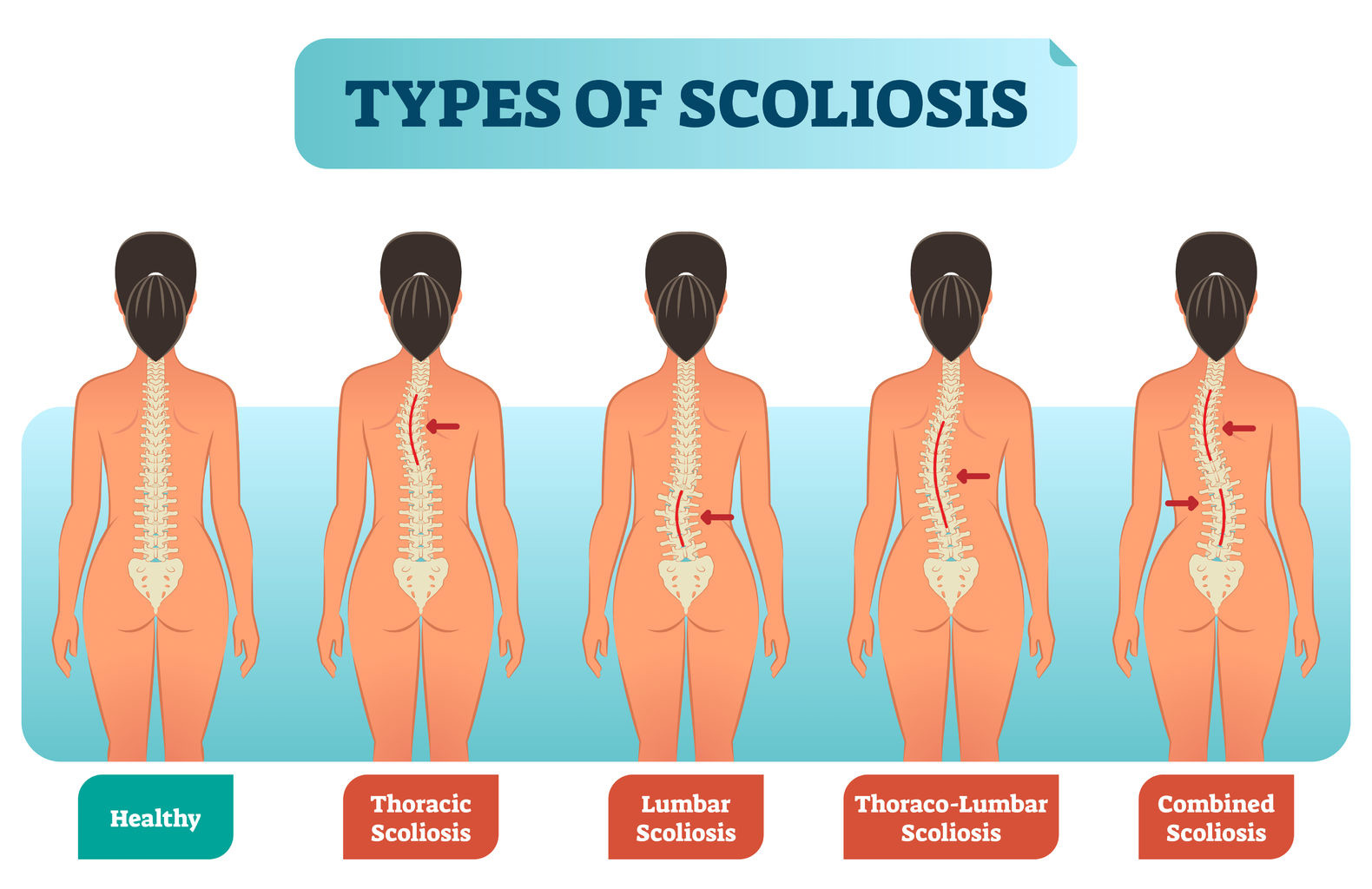 Scholarships for Students with Scoliosis 2024/2025