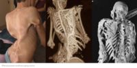 The Fate Of A Human Statue; Fibrodysplasia Ossificans Progressiva