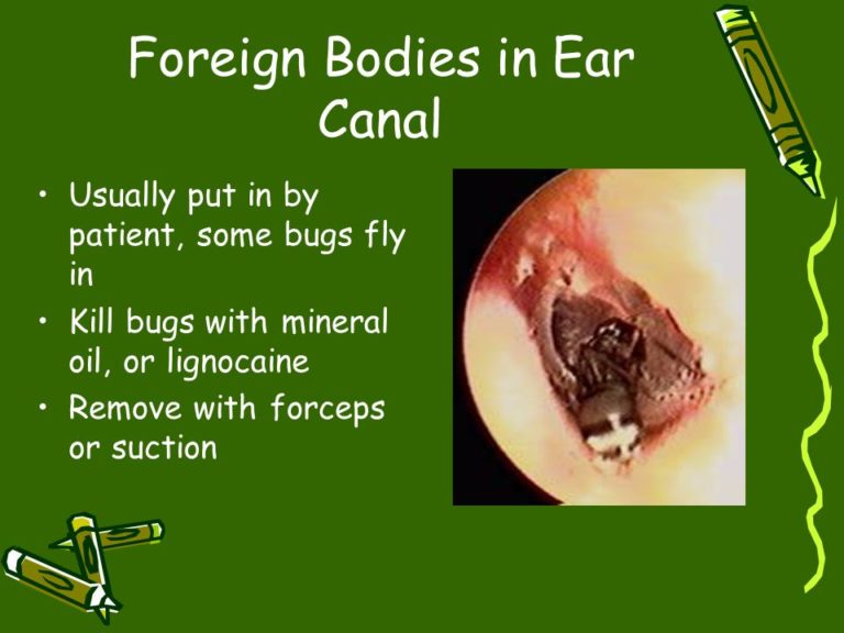 corneal-foreign-body-this-is-a-rust-ring-which-shows-sig-flickr