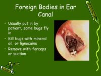 The Incidence Of Ear Foreign Bodies