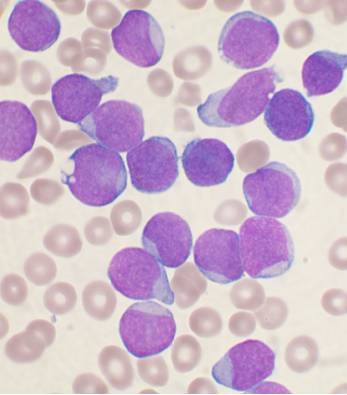 College Scholarships Dealing with Leukemia