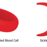 College Scholarships Dealing with Sickle Cell Anemia