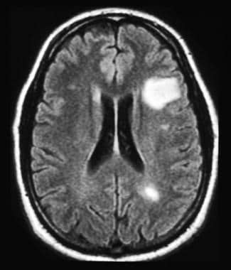 Scholarships For Multiple Sclerosis