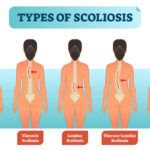 Scholarships for Students with Scoliosis